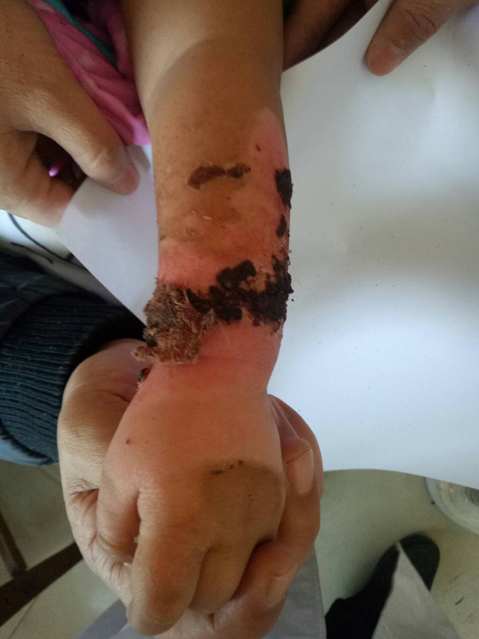 曹妃甸开水烫伤的十一个月小宝宝通过十天独家秘方调治现在完全没有