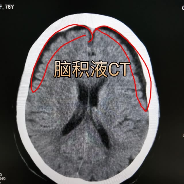 额部硬膜下积液 圈内黑萌萌域 145       赞                   评论