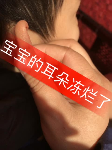 这才什么时候呀,耳朵就冻坏了,再冷的话怎么办呐 960       赞