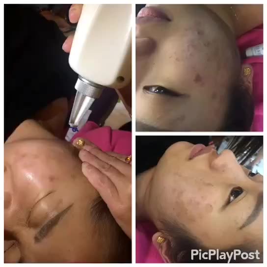 正在激光 药水提取真皮斑 127       赞       4月前