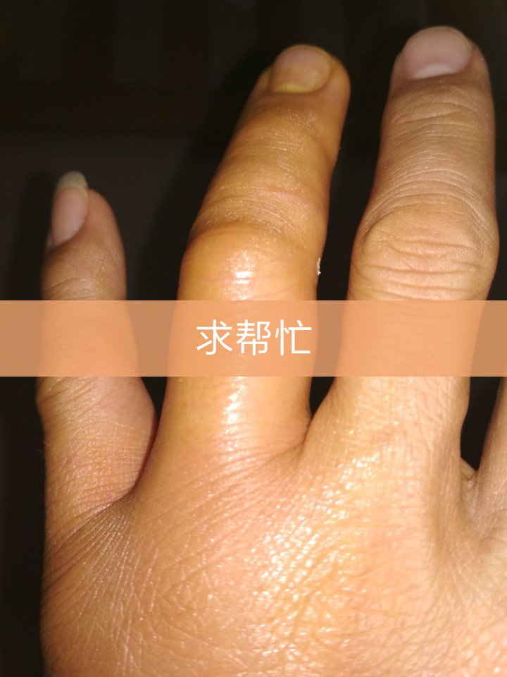 被蜜蜂蛰了一下,肿了两天都没好,有谁知道用什么药可以