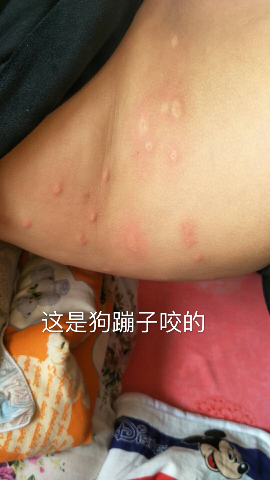 看看这是狗蹦子咬的,用了天萃荷净后,立马止痒的哈