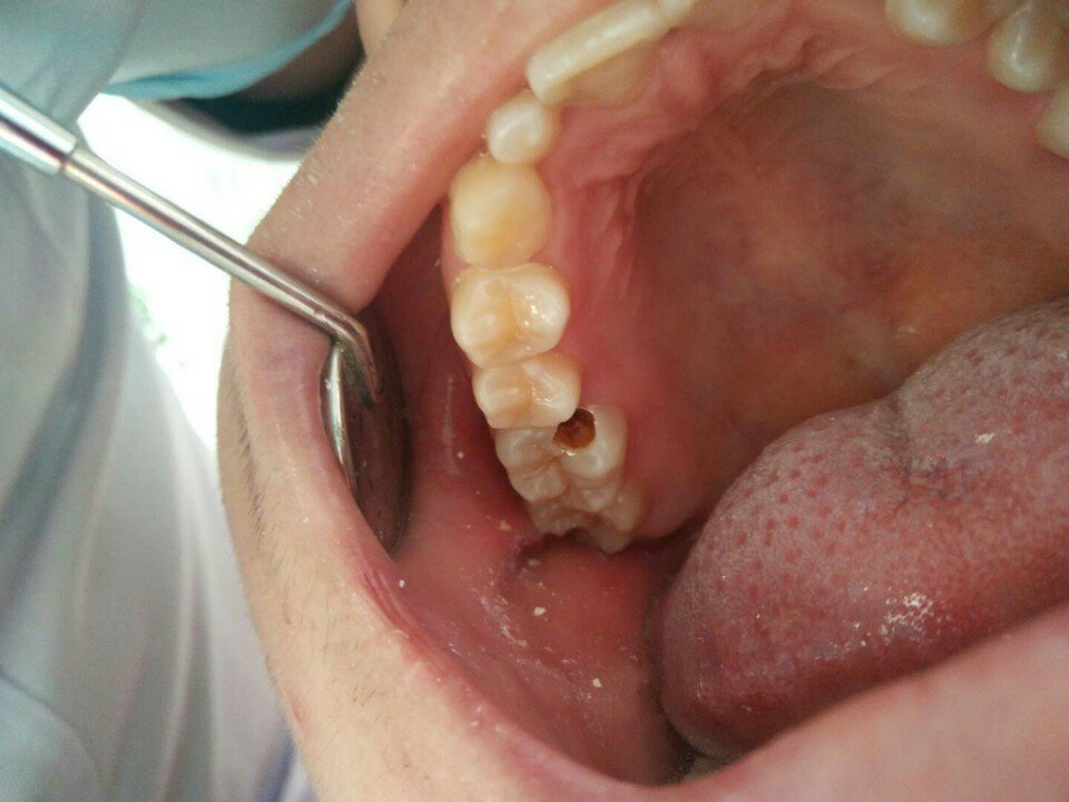 有牙洞要赶紧补上,真的不伤不起呀 8748        赞