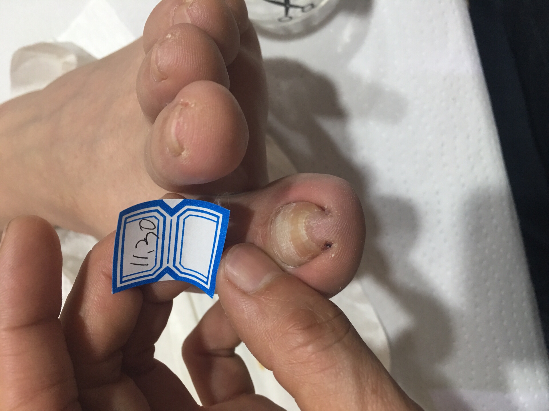 严重嵌甲3次效果对比!