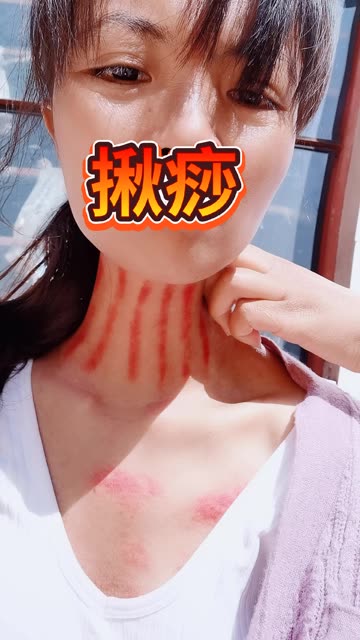 揪痧##快手# @快手 来自紫悦958 - 微博
